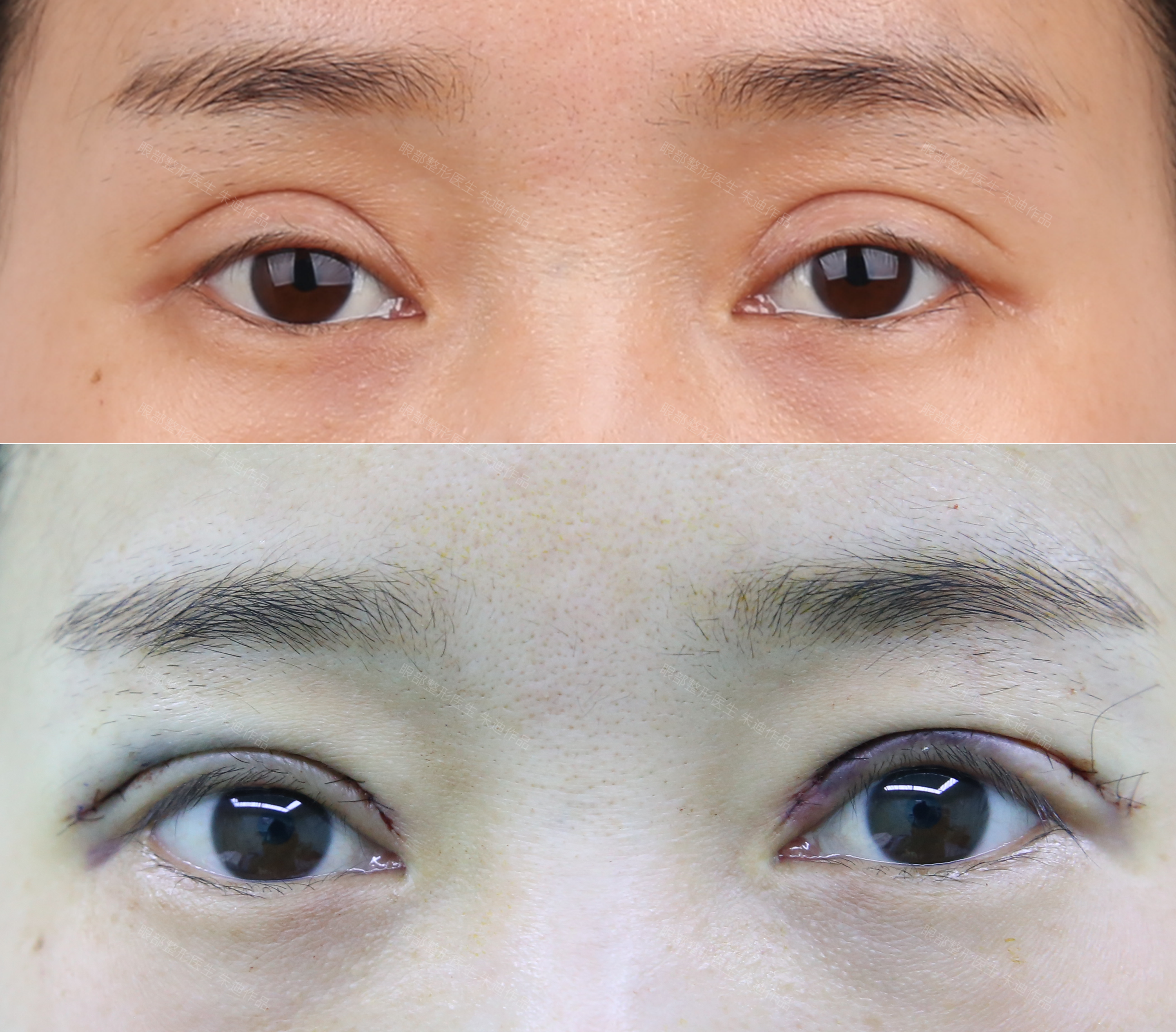 双眼皮失败司法鉴定费用（做双眼皮要花多少钱）