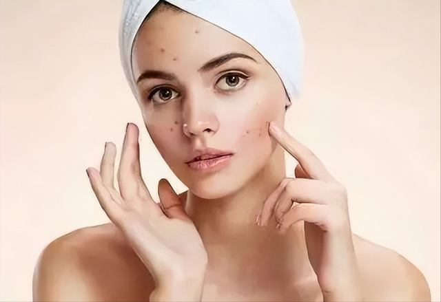 脸上痤疮怎么治，脸上痤疮怎么治才能彻底根除（满脸痘痘、痤疮）