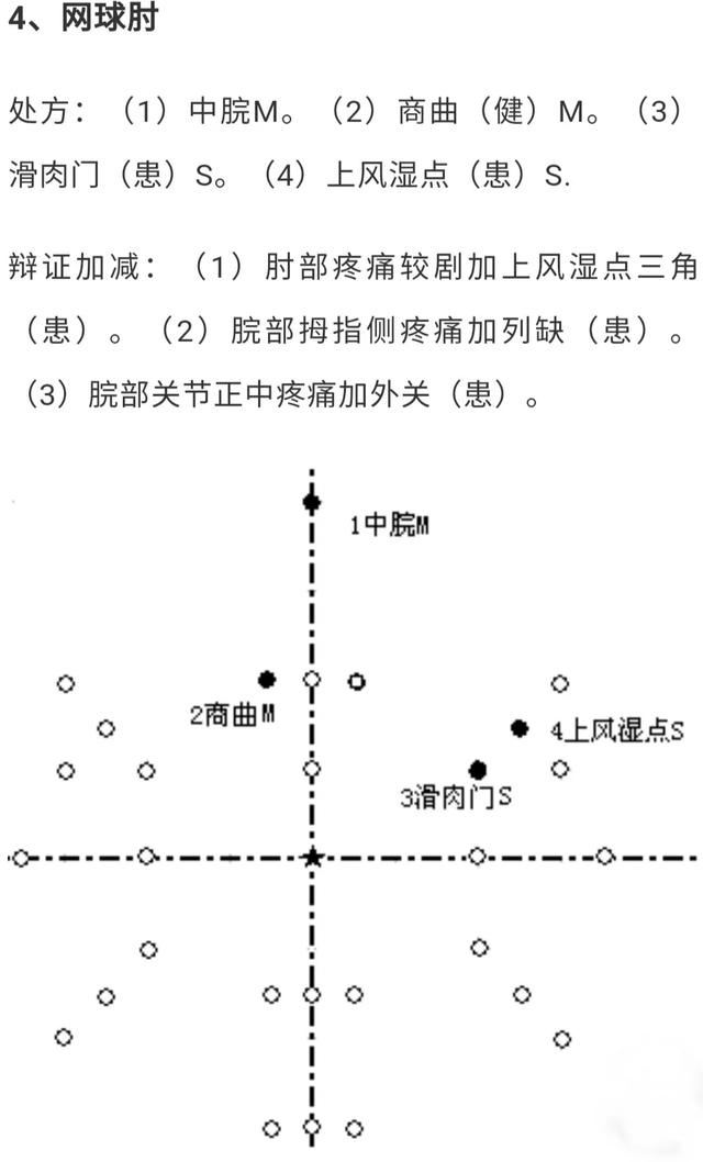 针灸减肥腹部八针法图片，什么是腹部针炙减肥（腹针疗法及常用腹针处方介绍）