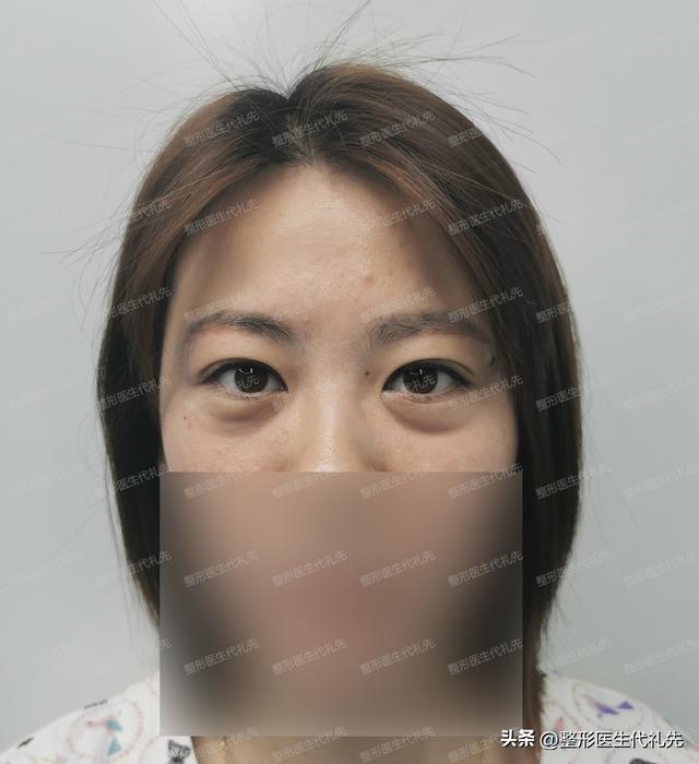 几招小秘方让你眼睛永远年轻，眼睛变大秘方（可以一台手术彻底解决吗）