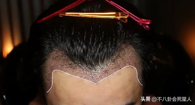 杨幂的发际线是什么样的，14位明星增发妙招