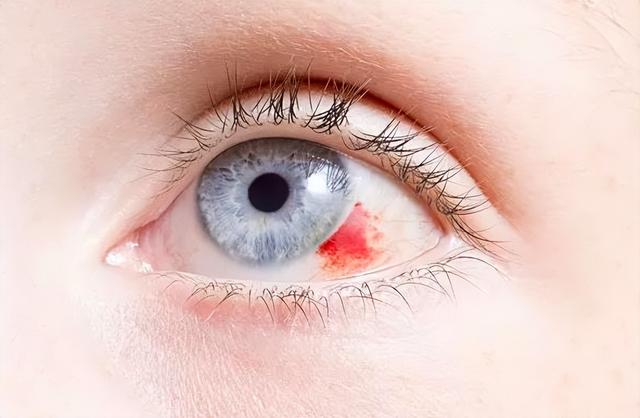 小孩眼睛红血丝是怎么回事，儿童眼睛红血丝怎么回事（眼里有红血丝是怎么回事）