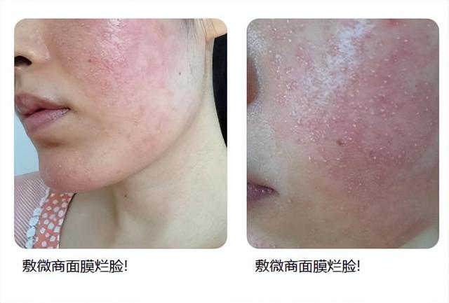 脸部能天天热敷吗，热敷脸有哪些功效与作用（面膜可以天天敷吗）