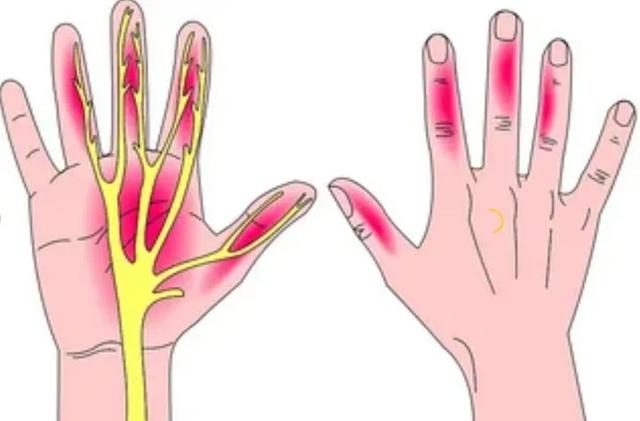 手指尖发麻怎么办，手指发麻怎么办（哈尔滨神经内科医院丨总感觉手指发麻）