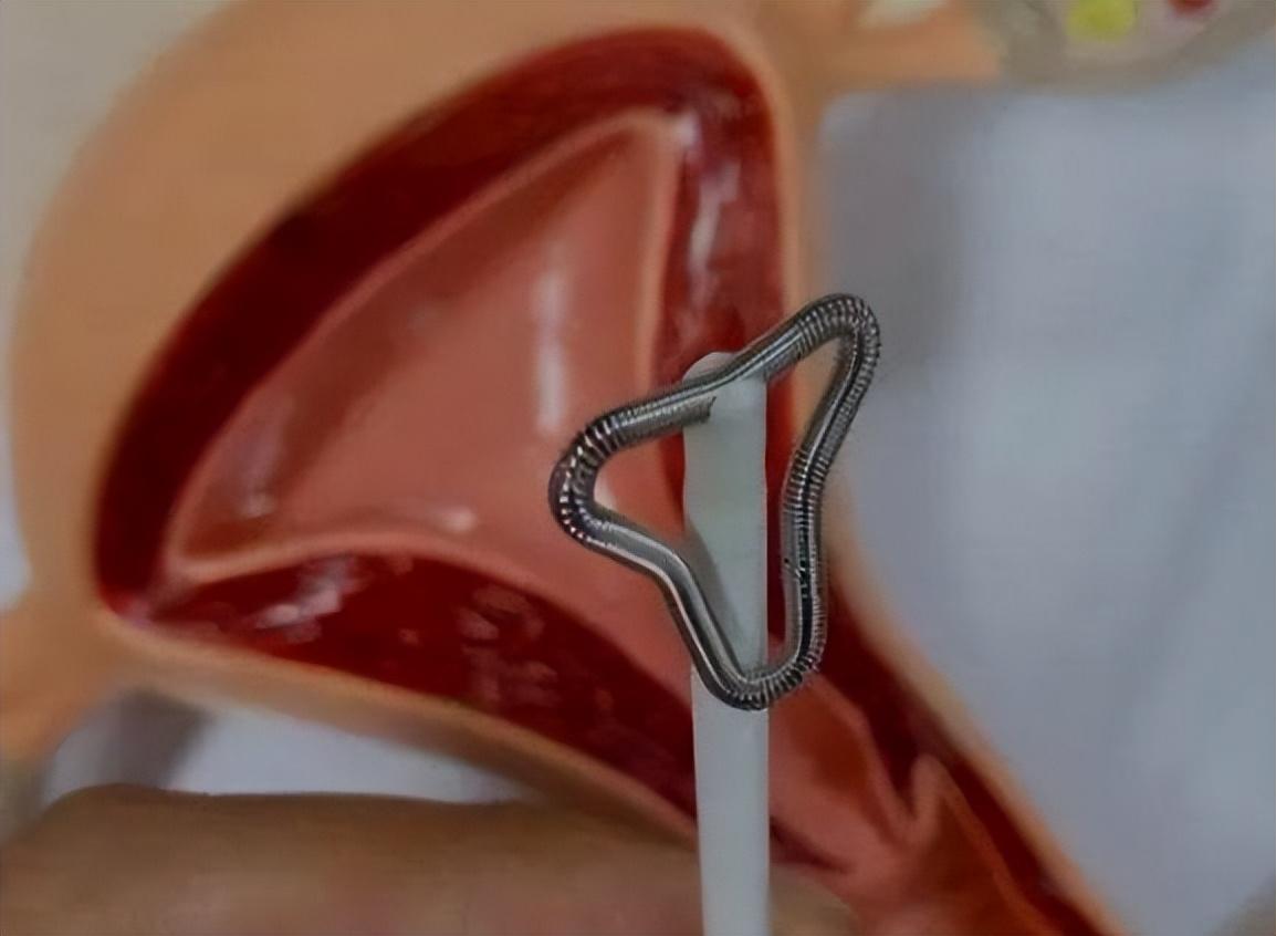 女性都要安装节育环吗?