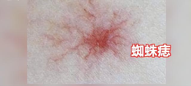 长红色的痣是有什么预兆，其中一种是肝癌的信号