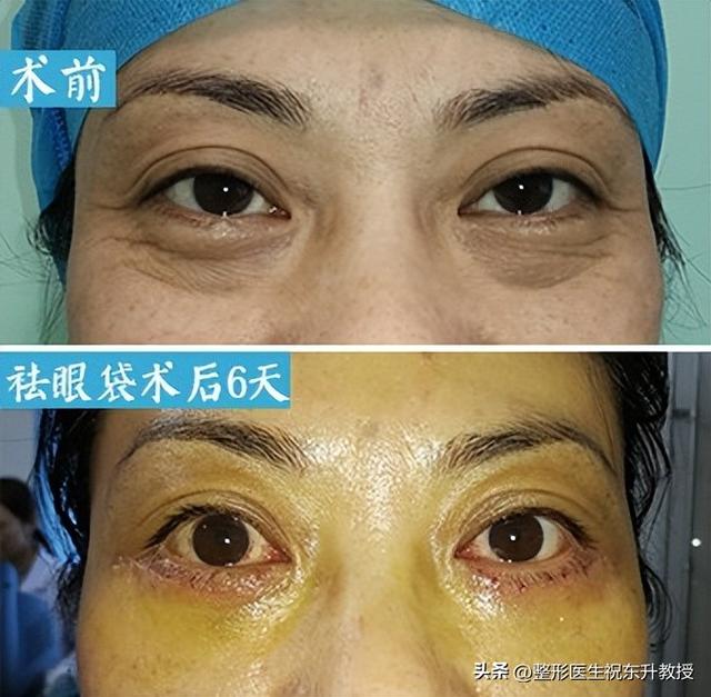 内切法去眼袋做完要多久时间，内切法去眼袋做完要多久时间可以化妆（作为做过眼袋手术的过来人）