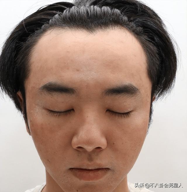 整容后遗症有哪些，整容后遗症有哪一些（明星整容后遗症明显）