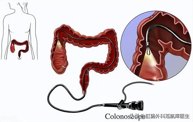 肠粘连是什么症状，子宫切除后肠粘连是什么症状（肠粘连可以做肠镜吗）