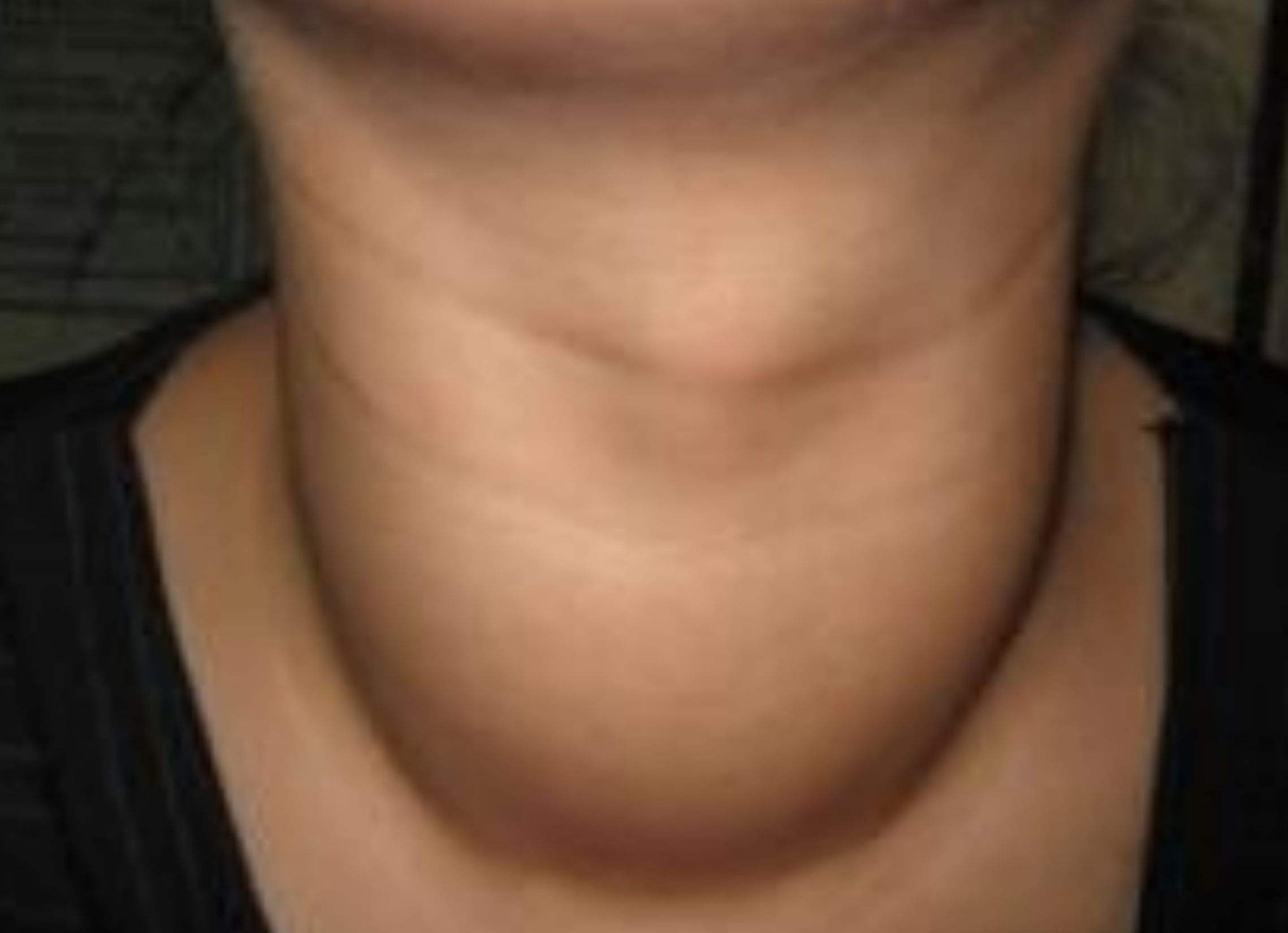 甲亢不是小问题,别光顾着"大脖子"