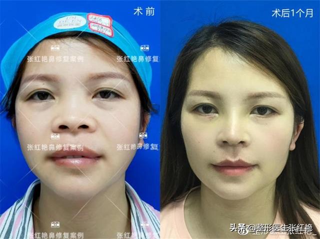 鼻孔大怎么办，鼻子太大怎么自然缩小（成功改造后气质“大变样”）