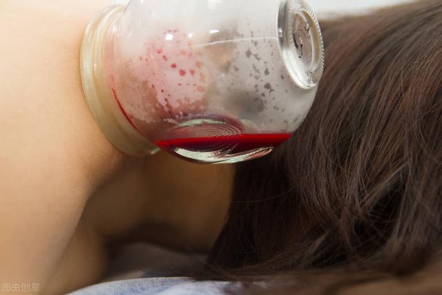 拔火罐颜色，拔火罐颜色越深湿气越重吗（拔罐，你拔出了什么）