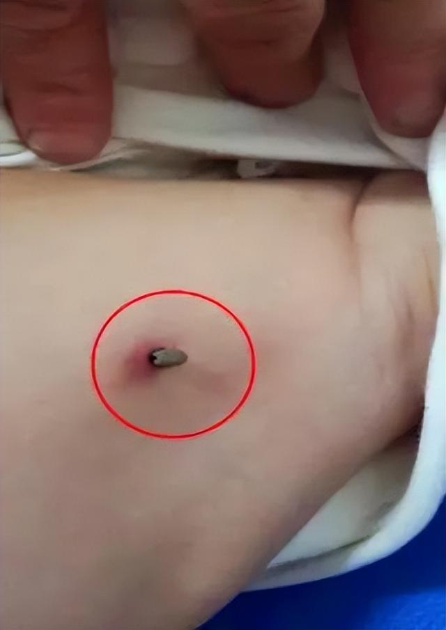 蜱虫是什么，可致命：夏季出游当心此虫（蜱虫是什么样的毒虫）