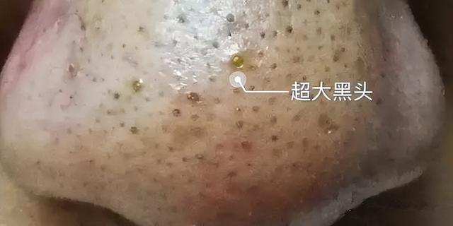 小气泡标准操作流程，美容机构的小气泡去黑头效果好吗