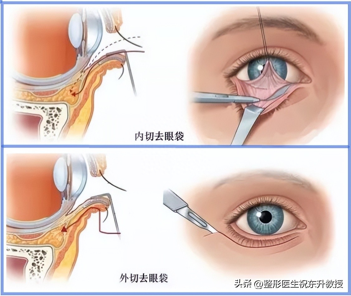 做眼袋手术价格表图片,哪家做眼袋手术好多