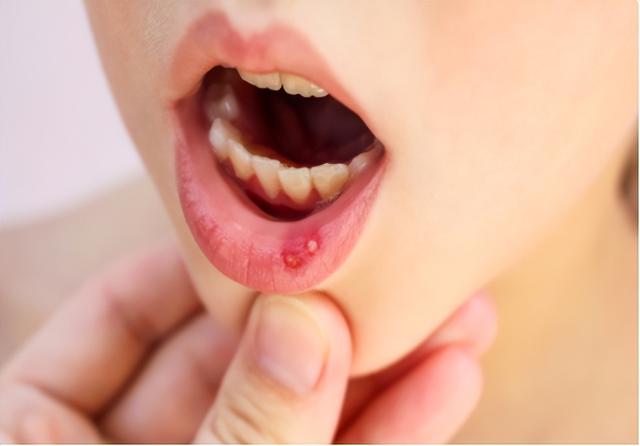 嘴巴经常长口腔溃疡什么原因，嘴巴经常溃疡是什么原因（口腔溃疡反复发作）
