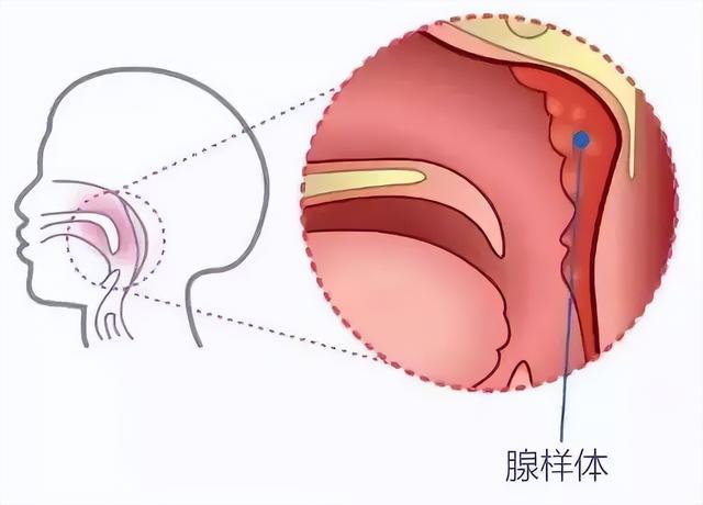 腺样体肥大是什么症状小孩怎么治疗，小孩腺样体肥大是什么症状（可能是腺样体肥大）