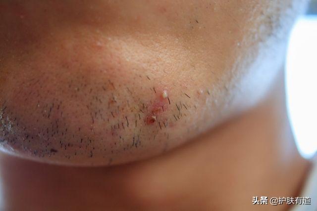 长暗疮怎么办，一直长暗疮怎么办（ 拆解8个暗疮部位）