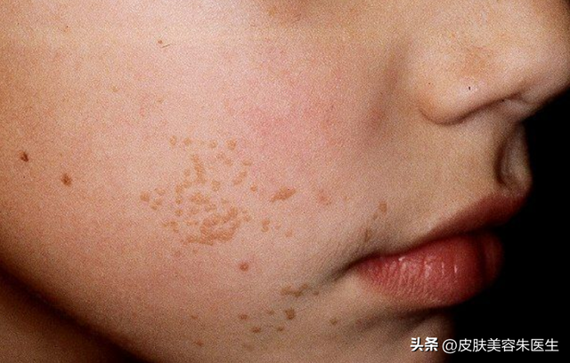 疣的分类与治疗，还有这几种疣也很常见