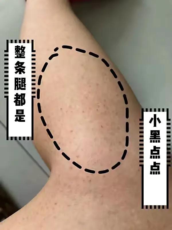 身体皮肤粗糙怎么办,身体皮肤很粗糙怎么办(帮你养成丝绸般光滑的皮肤