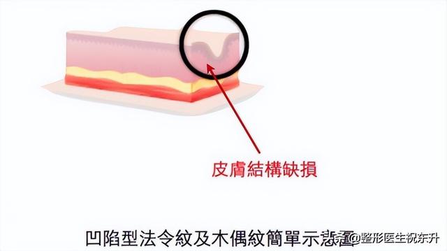 怎样淡化法令纹，怎么淡化法令纹（这“3个方法”实用又有效）