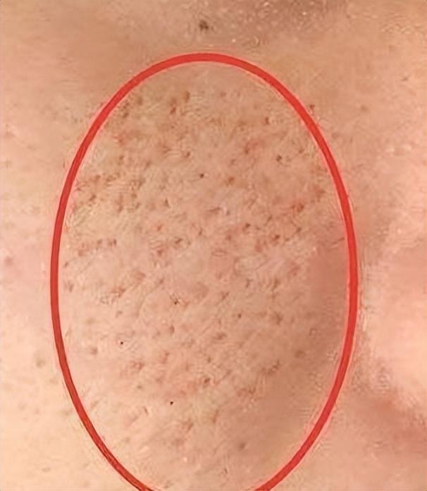 毛孔粗大怎么修复，毛孔粗大改善方法（毛孔粗大很绝望）