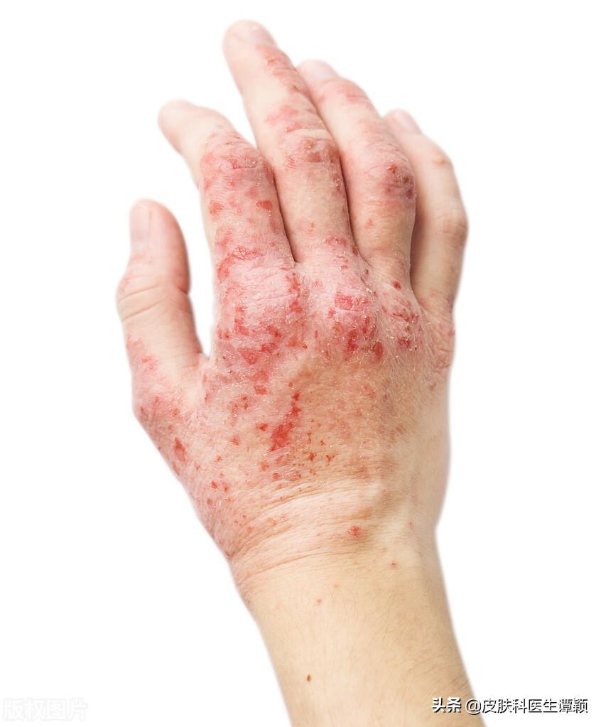 什么是湿疹?什么原因能引起湿疹?湿疹有什么表现?