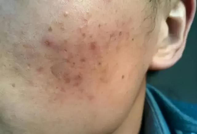 男士祛痘印的小窍门，男士祛痘印小窍门（男生痘印如何去除）