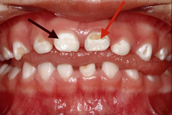 宝宝牙釉质脱落怎么办图片