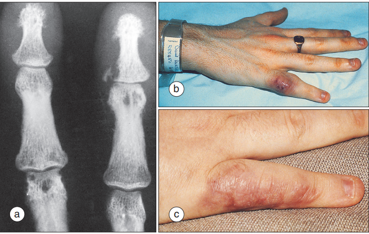 六,结节性关节病