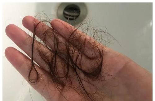 洗头时大量掉发怎么办，洗头的时候严重掉发怎么办（提醒：平时远离这3物）