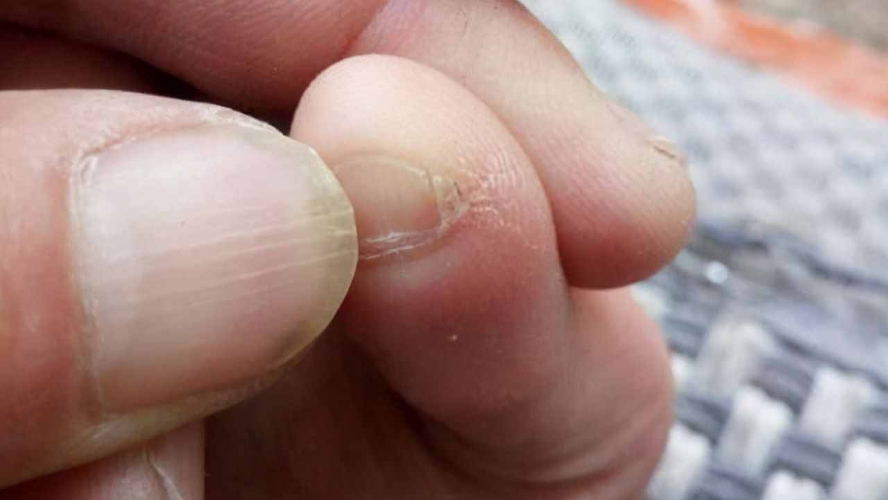 是指人的一侧或双侧脚的小脚趾指甲呈两瓣或三瓣等多瓣状.