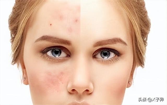 上火长痘痘怎么办，天热上火长痘怎么办（脸上长痘咋办，正确着手才能好）