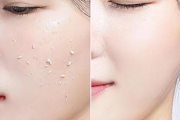 毛孔粗大怎么修复，毛孔粗大改善方法（毛孔粗大很绝望）