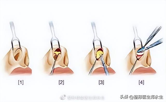 鼻头缩小术千万别做，鼻缩小手术千万别做（肉鼻子做了鼻头缩小结果越“缩”越“大”）