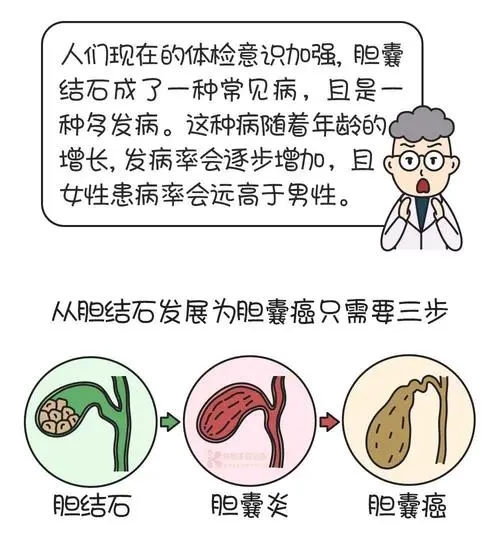 四,胆囊切除之后的危害是什么?