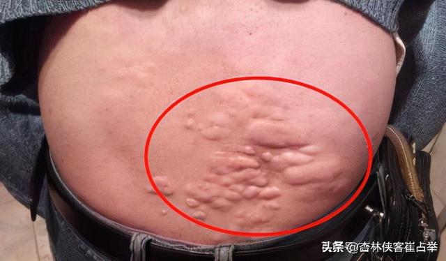 白矾的功效与作用，白矾外敷的功效与作用（结节、囊肿、增生）