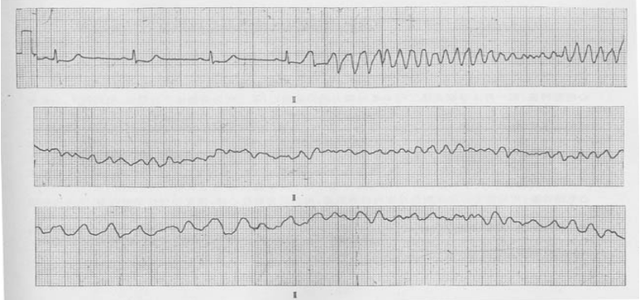 什么是大炮音，大炮音是怎样产生的（心律失常<五>）