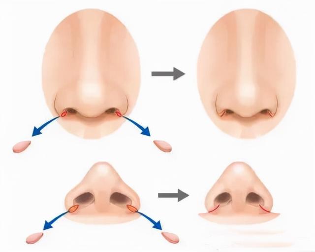 鼻头肉多怎么减，如何减掉鼻头上的肉（鼻头肥大不一定要切鼻翼）