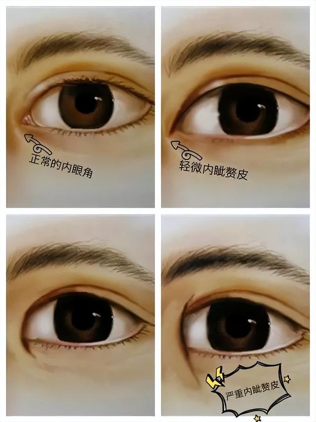 割双眼皮最佳季节，双眼皮6 7 8毫米效果图（开眼角手术答疑解惑）