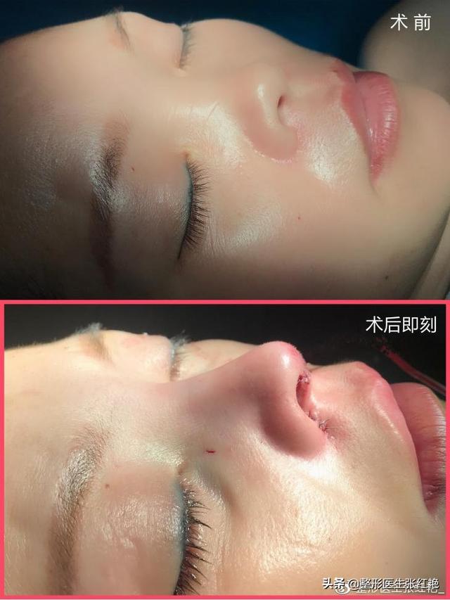 鼻孔大怎么办，鼻子太大怎么自然缩小（成功改造后气质“大变样”）