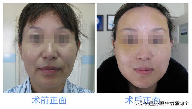 面部提升除皱的原理，面部除皱效果（面部除皱这3种方法还不错）