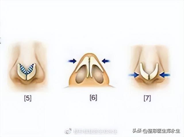 鼻头缩小术千万别做，鼻缩小手术千万别做（肉鼻子做了鼻头缩小结果越“缩”越“大”）