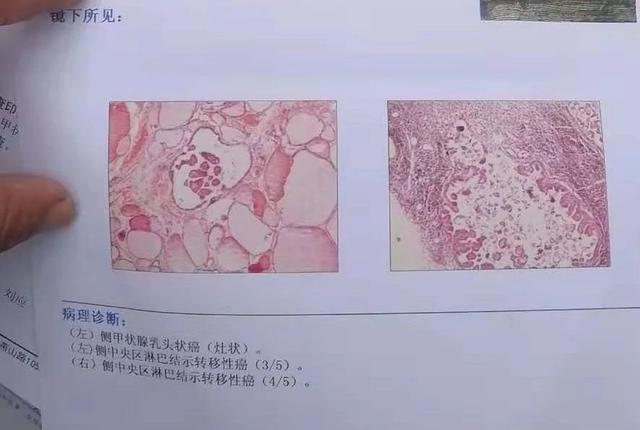 甲状腺4a必须手术吗，甲状腺4a类需要做手术吗（查出甲状腺结节4a类怎么治疗）