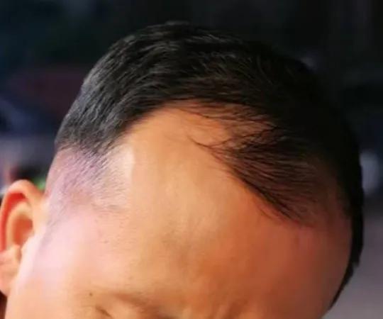 眉毛种植疼吗，种植眉毛有用吗（16000字讲述植发真实感受）