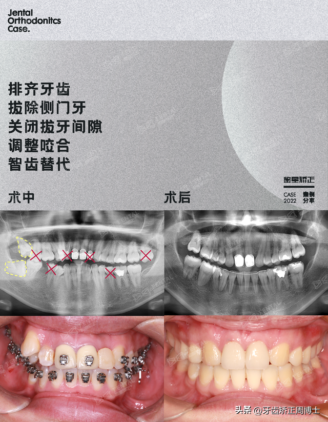 牙齿矫正图(牙齿矫正类型)-宅配通娱网