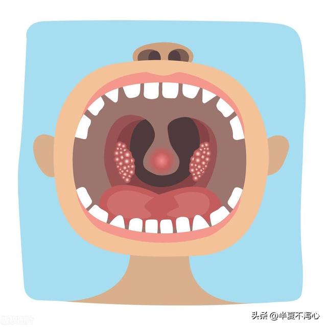 扁桃体发炎偏方，扁桃体发炎偏方立刻见效（扁桃体发炎反反复复）