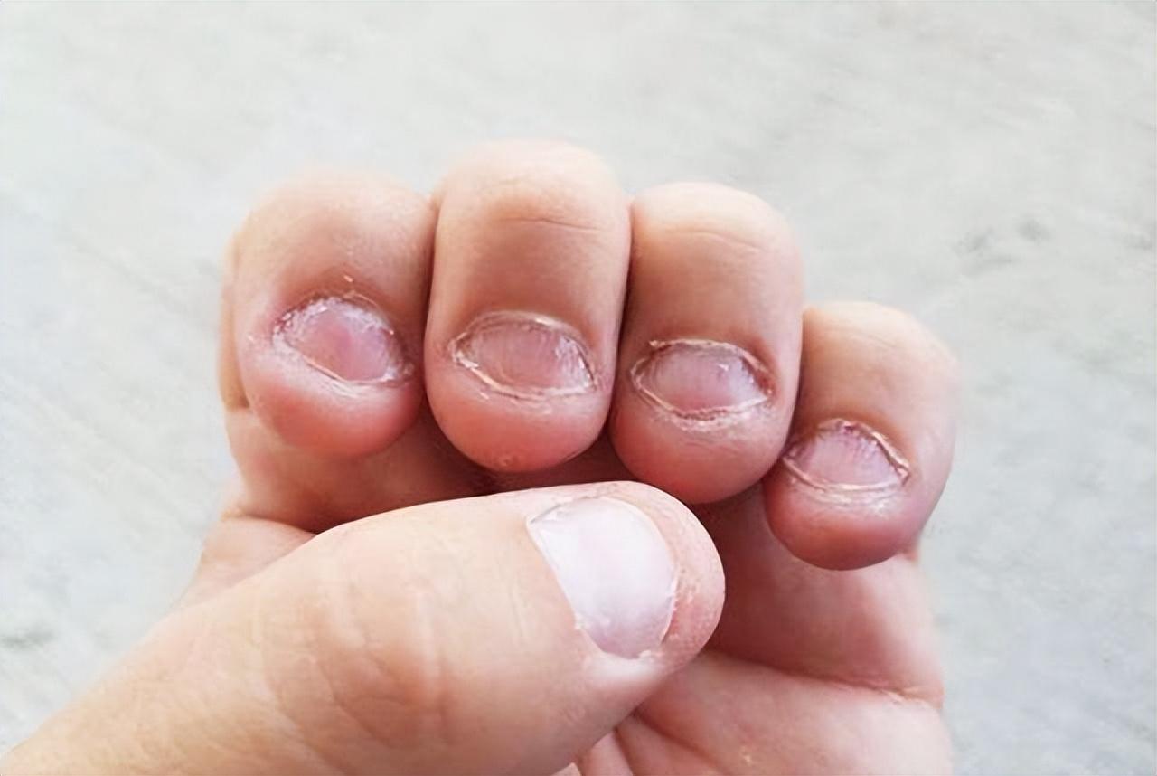 指甲盖短小的命苦,从小爱咬指甲的孩子 - 玉三网