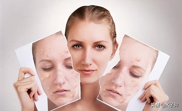 上火长痘痘怎么办，天热上火长痘怎么办（脸上长痘咋办，正确着手才能好）