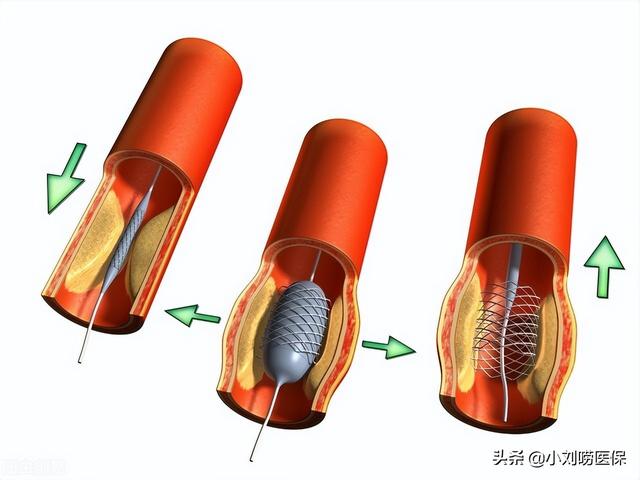 做心脏支架的费用清单，心脏支架从1.3万降到了700元